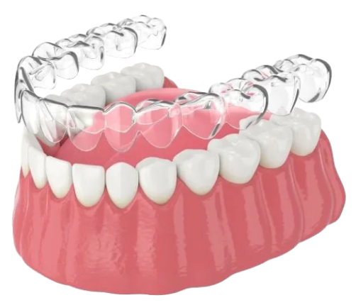 Clear Aligners in Kerala - Digitace aligners