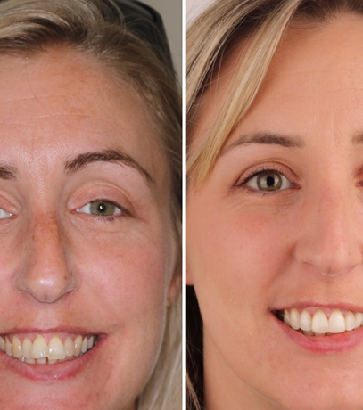 a before and after picture of a girl who used invisible aligners and got the best result