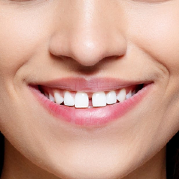 Clear Aligners in Kerala - Digitace aligners a photo of a disaligned teeth