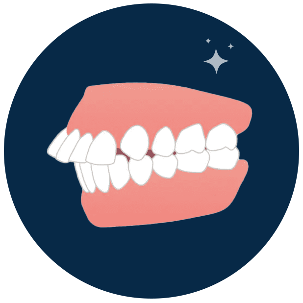 Clear Aligners in Kerala - Digitace aligners a photo of a disaligned teeth